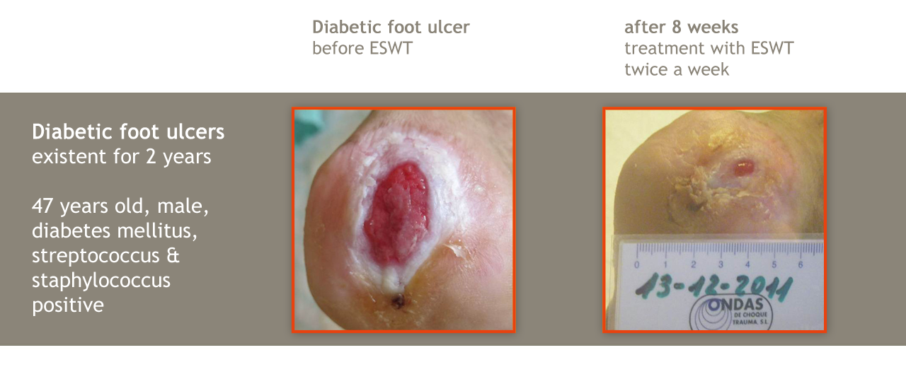 diabetic foot ulcer stages
